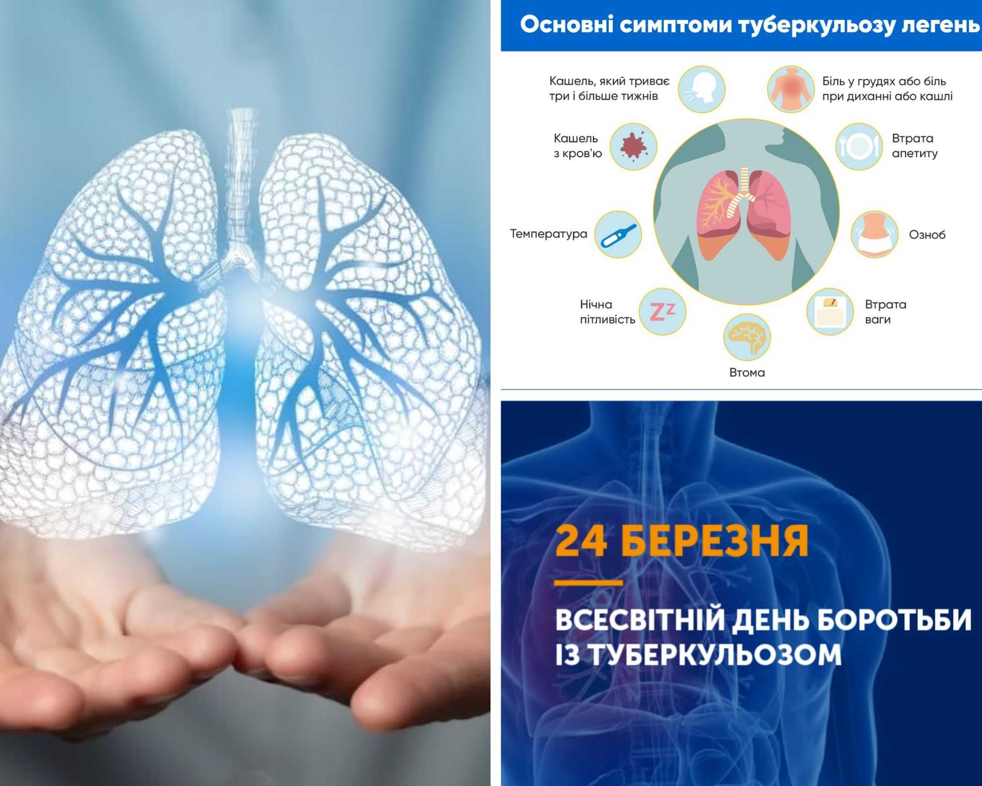 «ТАК! МИ МОЖЕМО ПОДОЛАТИ ТУБЕРКУЛЬОЗ!» Березень 2026 — Місячник подолання туберкульозу в Україні та світі